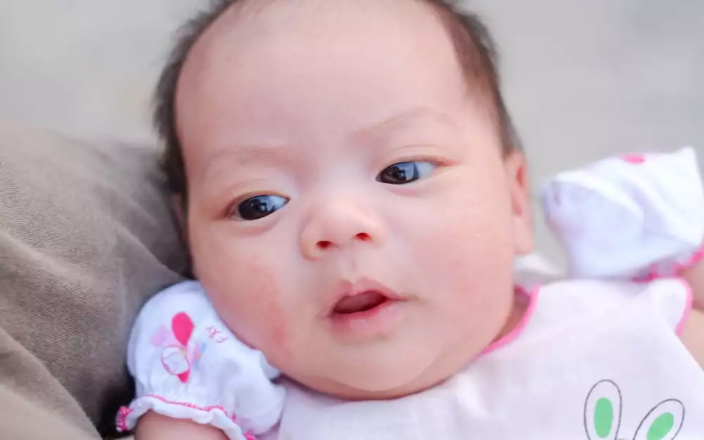 Potówki u niemowlaka - przyczyny, leczenie